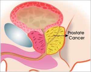 prostate gland removal surgery cost in india)